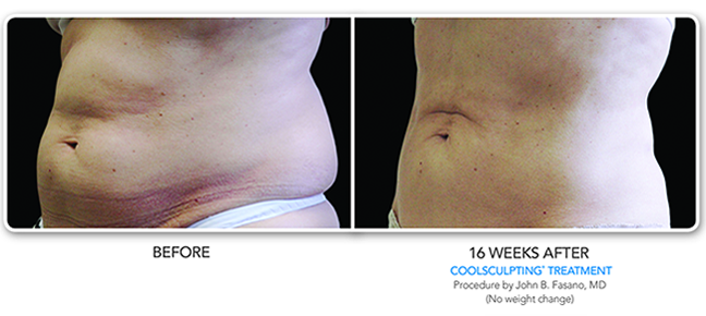 Before and after SculpSure