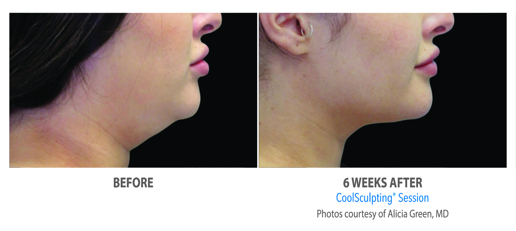 Before and after CoolSculpting treatments