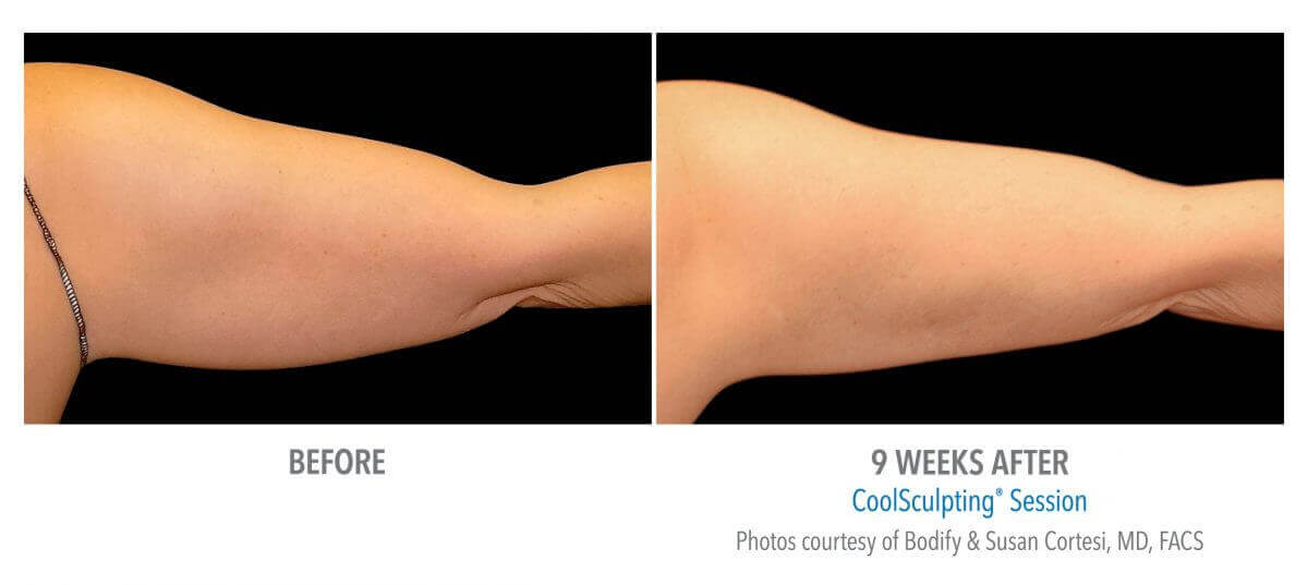 Before and after CoolSculpting treatments