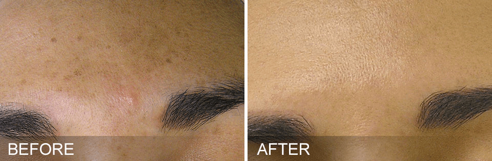 Before and after HydraFacial