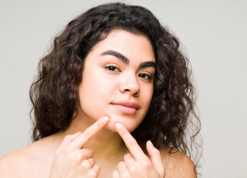 Photo of a young woman touching a pimple on her chin