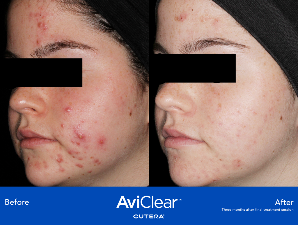 Before and after AviClear results